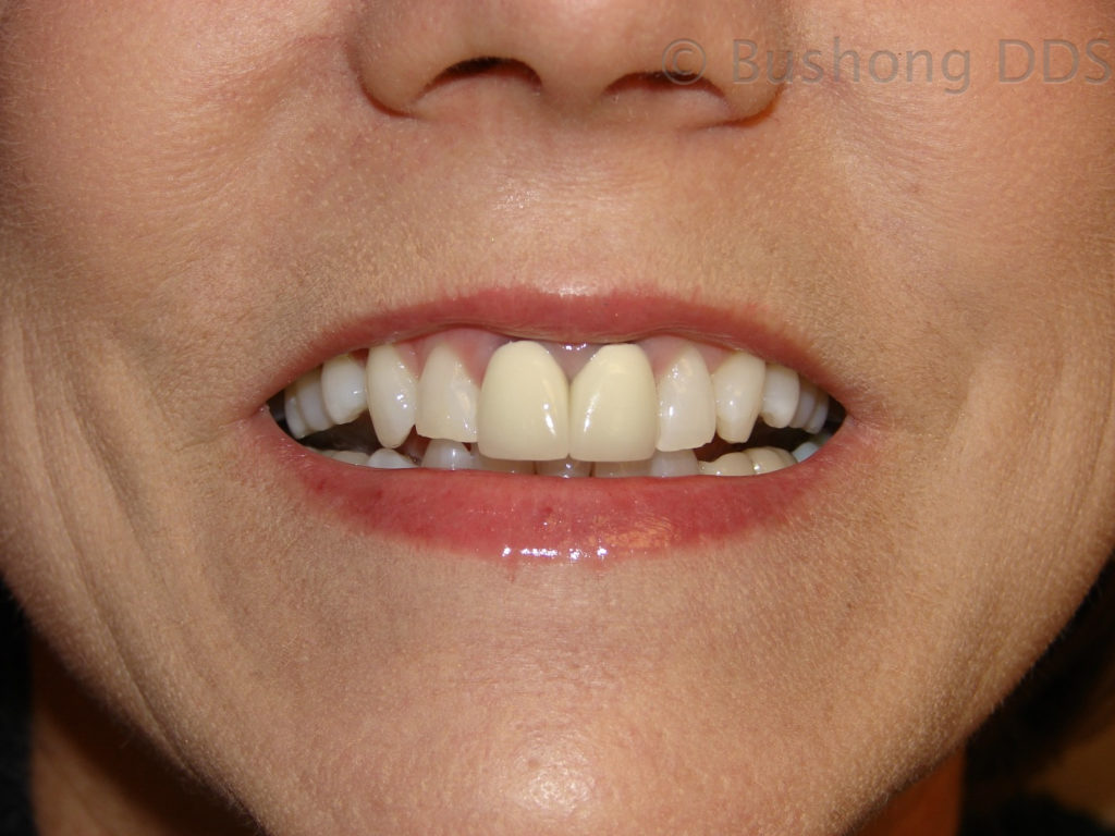 Crowns Before Image