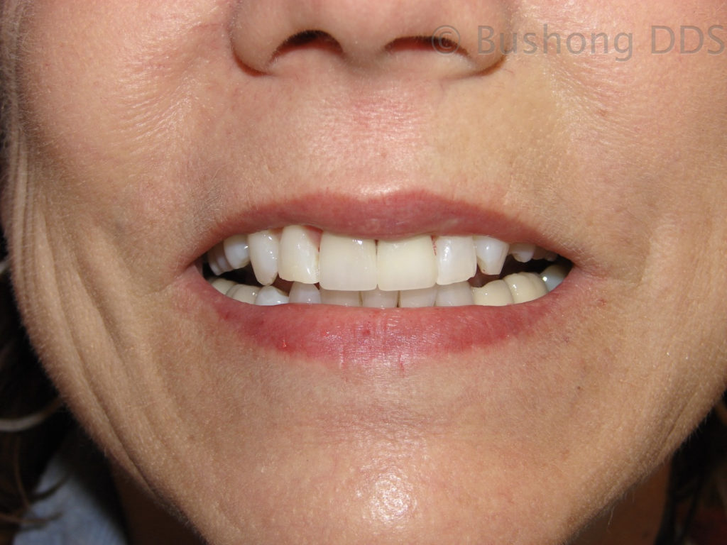 Crowns After Image