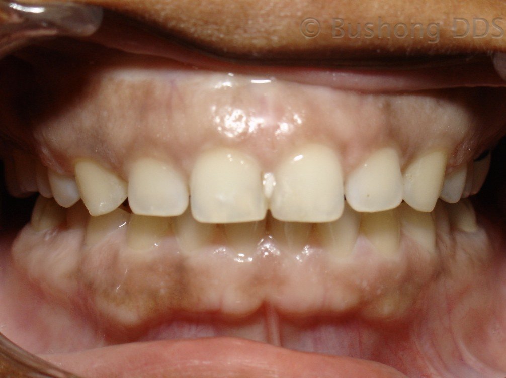 Fourth Crowns Before Image