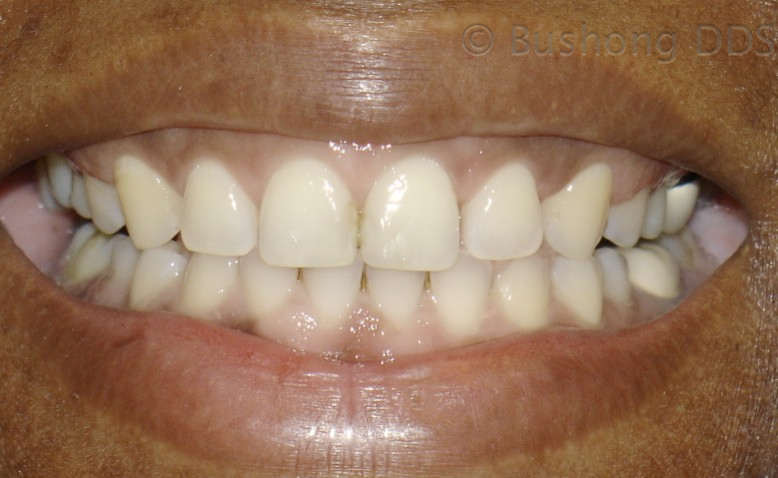 Fourth Crowns After Image