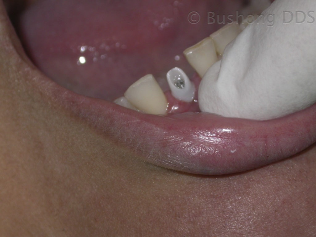 Implant Before Image
