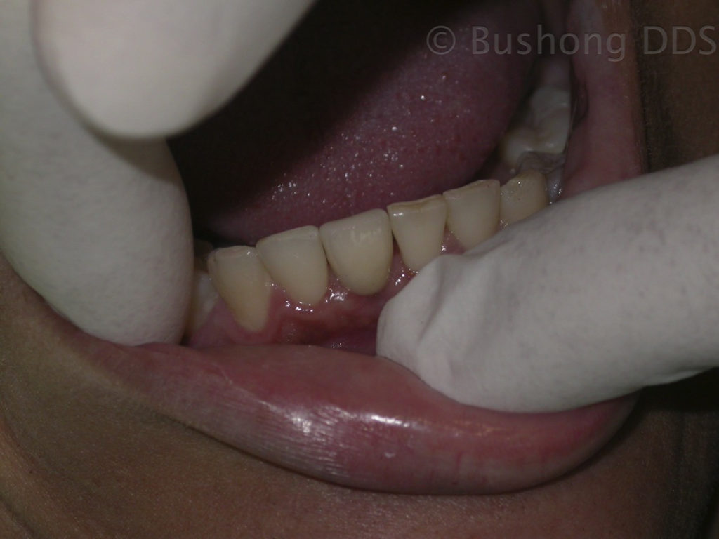 Implant After Image