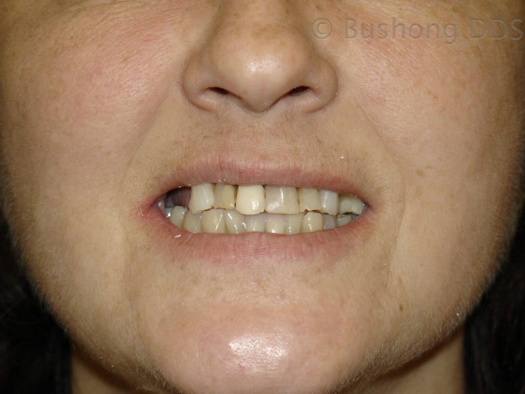 Second Crowns Before Image