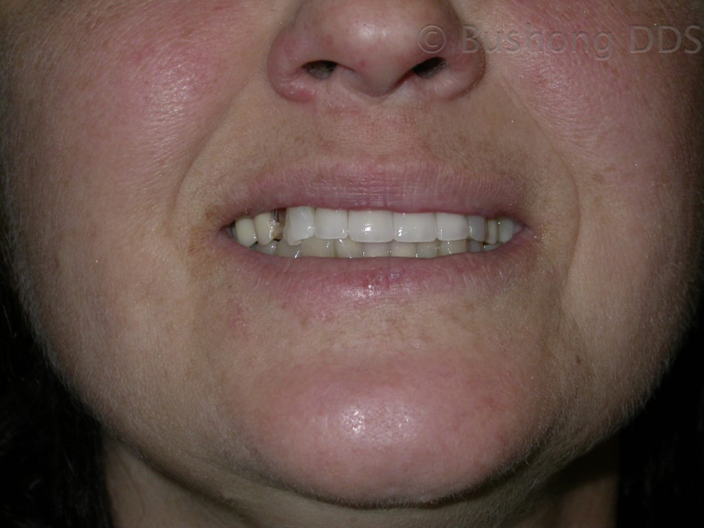 Second Crowns After Image