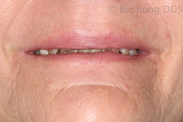 Third Crowns Before Image 1