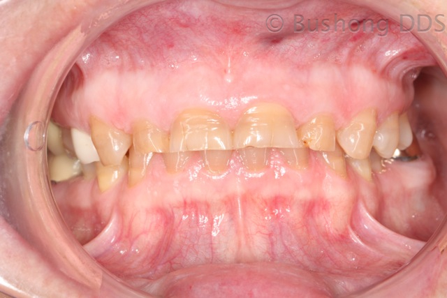 Third Crowns Before Image 2