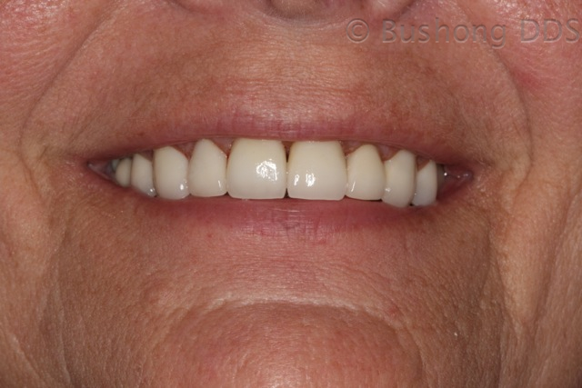 Third Crowns After Image 1