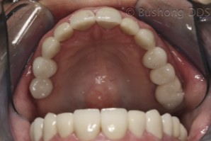 Third Crowns After Image 2