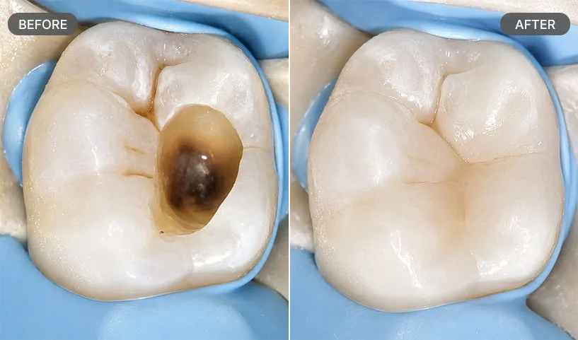 Cavity Filling Before and After