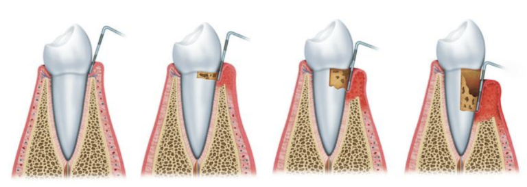 Tooth Decay